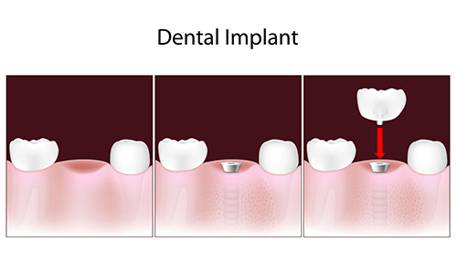 Dental Implants in Brooklyn
