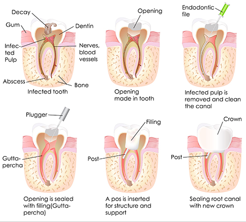 Root Canal in Brooklyn